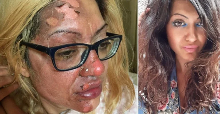Zjeu vezën me metodën që kishte mësuar në TikTok, 37-vjeçarja me djegie të rënda në fytyrë