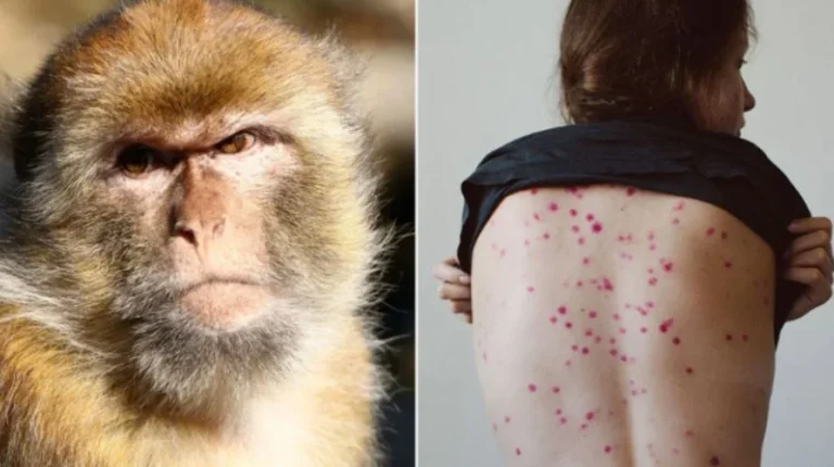 Lia e majmunit në Shqipëri, si u zbulua 31-vjeçari i prekur, shenjat dhe trajtimi i tij