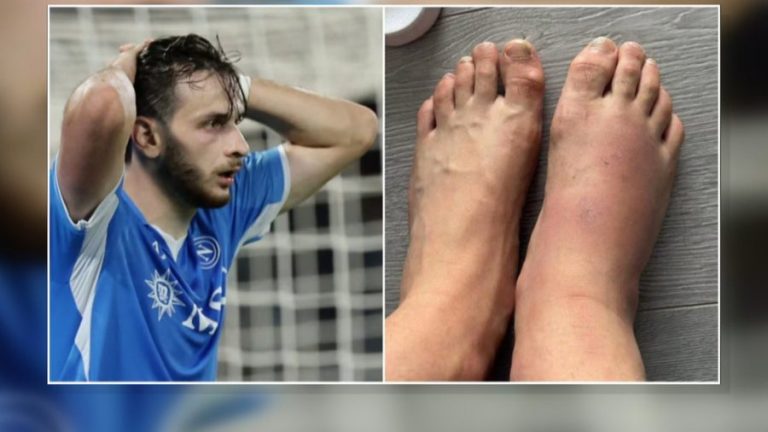 Me këmbë të enjtur dhe të nxirë, Kvaratskhelia rrezikon ndeshjen me Shqipërinë