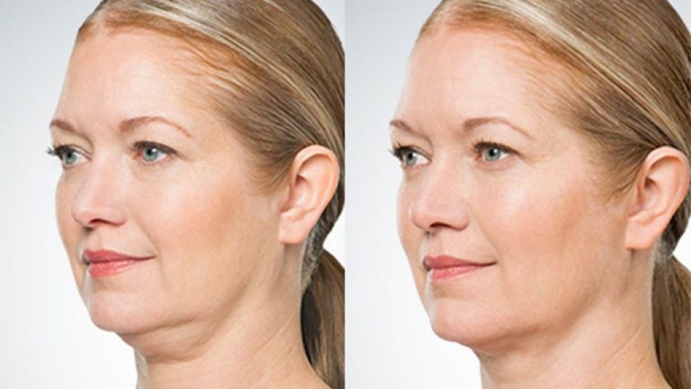 Këshillat më të Mira si të Largoni Gushën e Varur